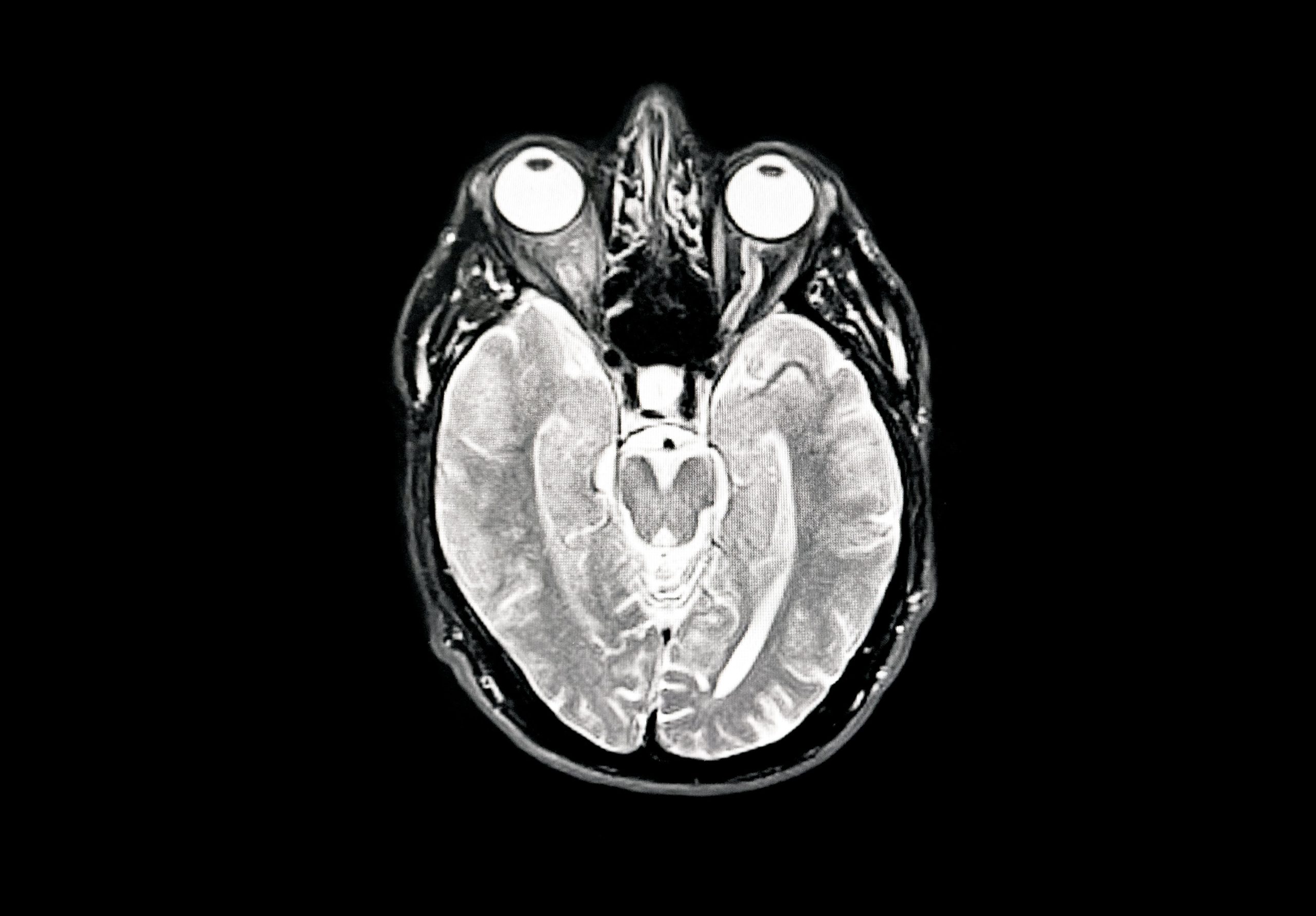 A black and white brain scan